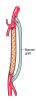 Surgical bypass graft to repair a blocked blood vessel